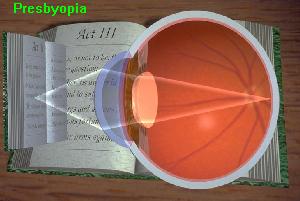 Presbyopia